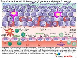 psoriasis