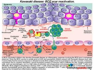 kawasaki disease: bcg scar reactivation