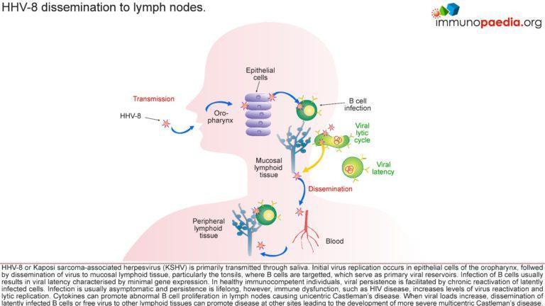 Multicentric Castleman’s disease Case Study | Immunopaedia