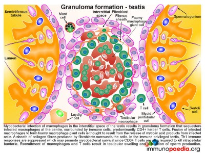 Testicular TB Case Study | Immunopaedia