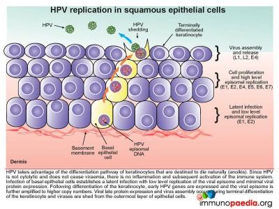 Giant Condyloma of Buschke and Lowenstein Case Study | Immunopaedia