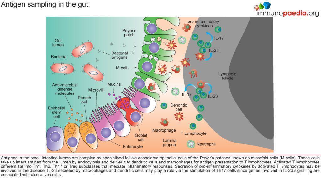 Ulcerative Colitis Case Study Immunopaedia