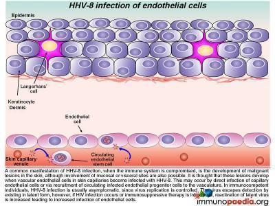 Pulmonary Kaposi Sarcoma Case Study | Immunopaedia