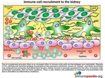 Post streptococcal glomerulonephritis Case Study | Immunopaedia