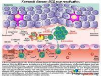 Kawasaki Disease Case Study | Immunopaedia