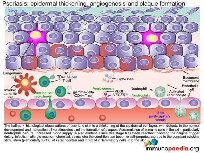 Severe Psoriasis vulgaris Case Study | Immunopaedia