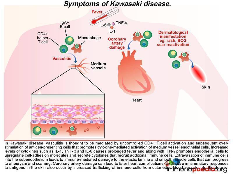 måtte historie dans Kawasaki Disease Case Study | Immunopaedia