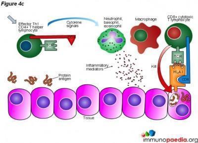 Arthus reaction Case Study | Immunopaedia