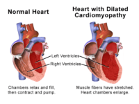 Hiv Nef Protein Implicated In Cardiomyopathy 