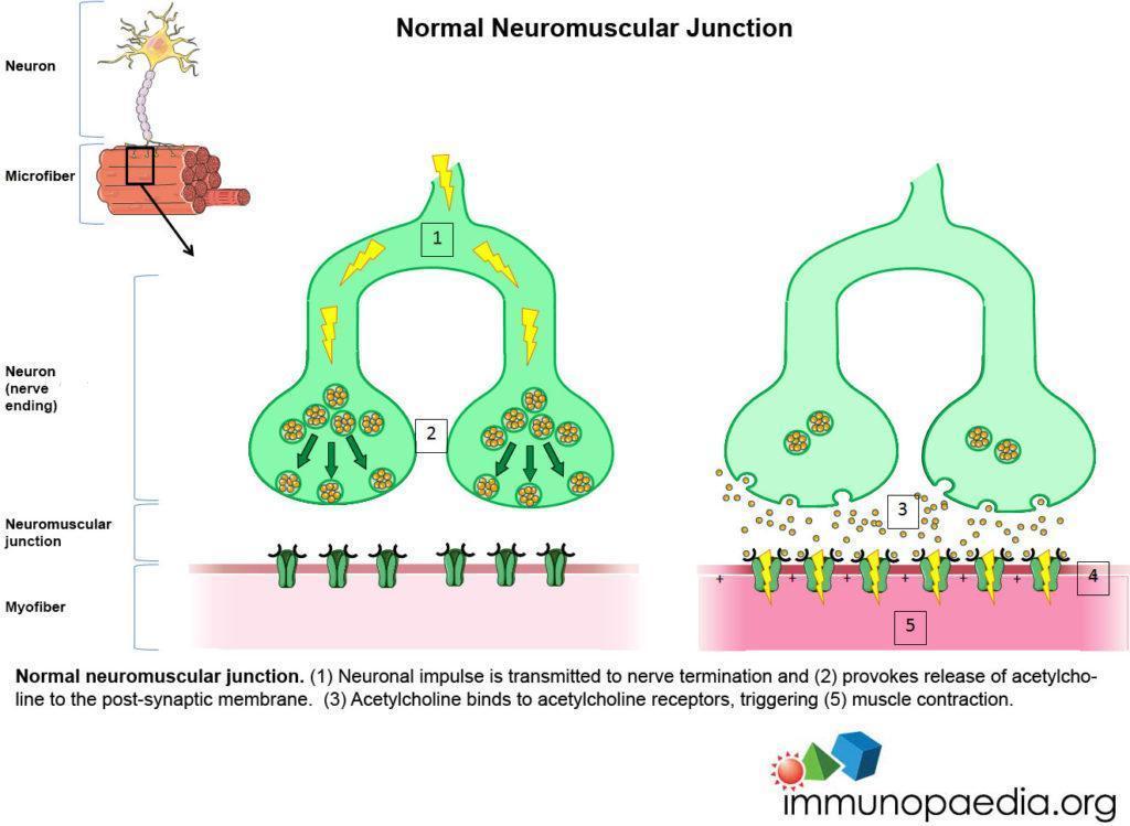 Myasthenia Gravis Case Study | Immunopaedia