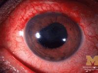 anterior uveitis