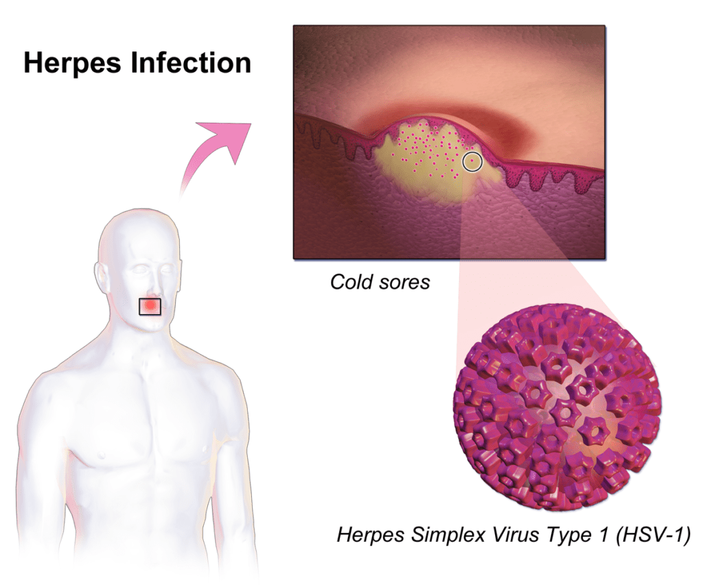 does-cxcl17-contribute-to-protection-against-herpes-immunopaedia