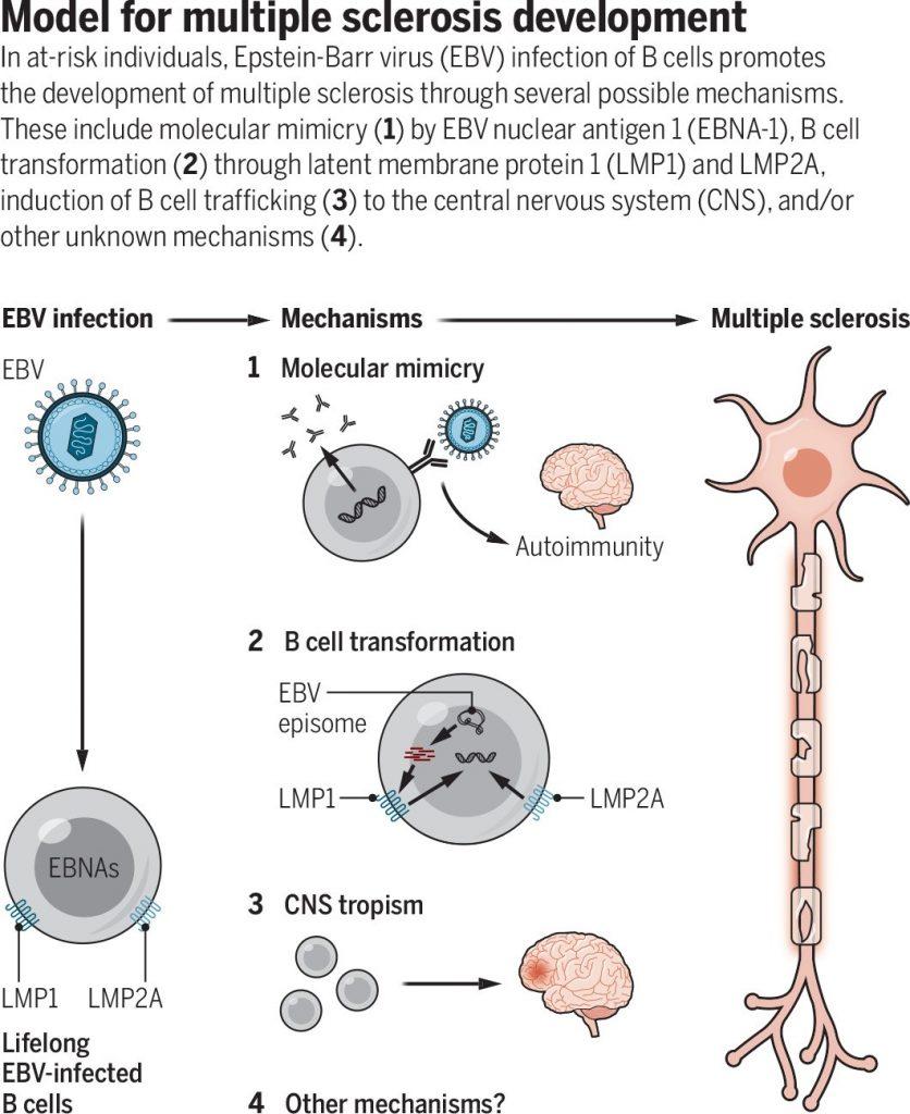 EpsteinBarr Virus found to trigger Multiple Sclerosis Immunopaedia