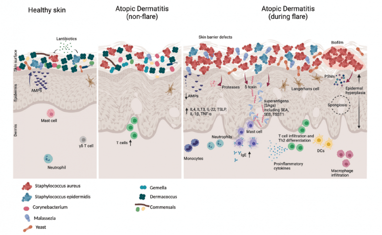 Atopic dermatitis and the skin microbiome | Immunopaedia